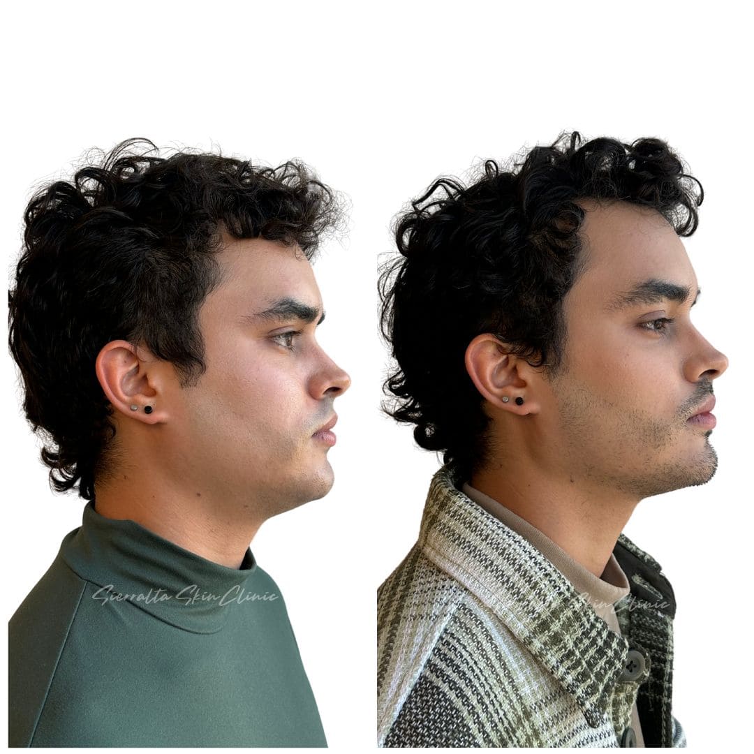 Armonización facial (desde 4 ml.) - Imagen 8
