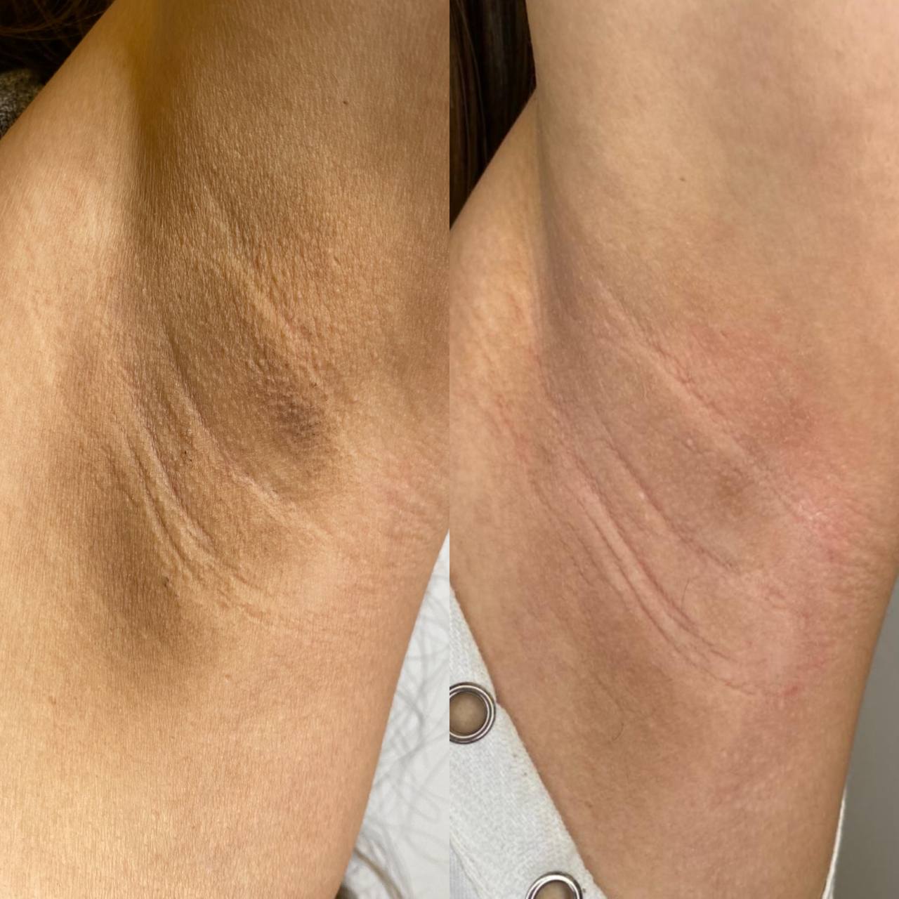 Meline Intimate (Zonas íntimas)