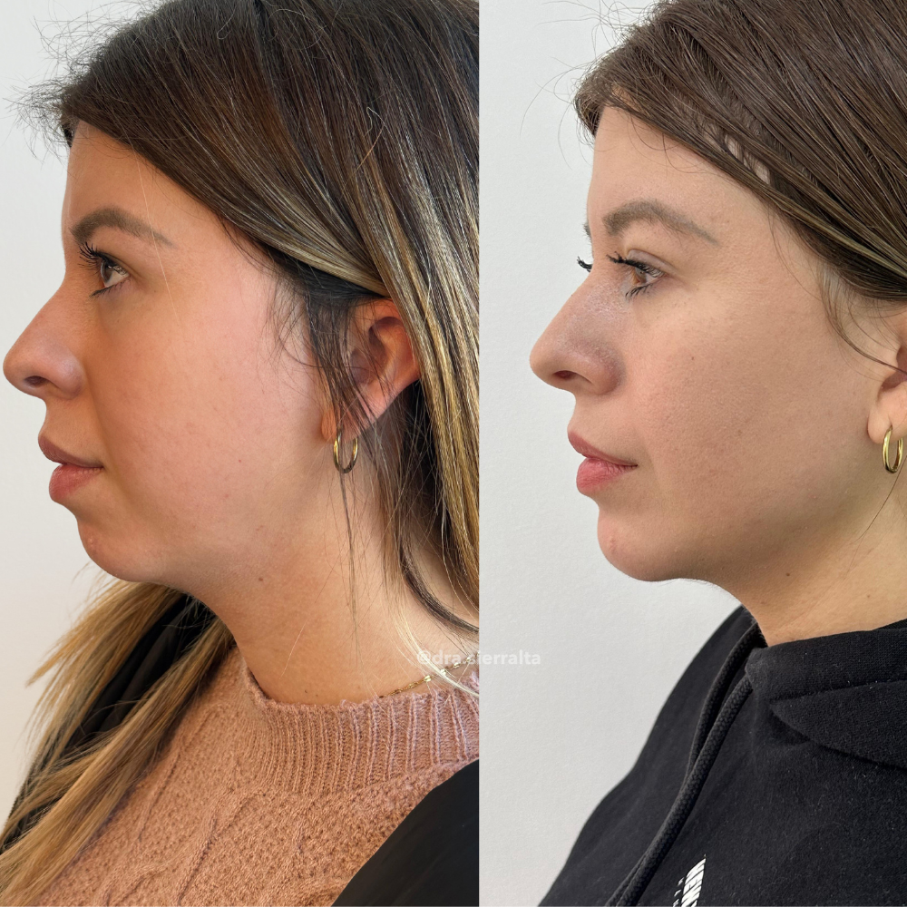 Definición de ángulo y reborde mandibular - Imagen 2