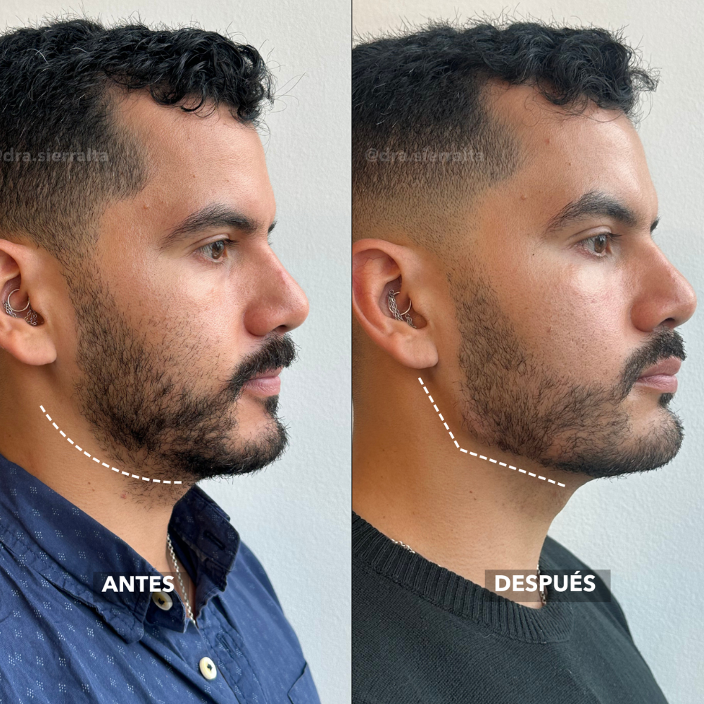 Definición de ángulo y reborde mandibular - Imagen 3