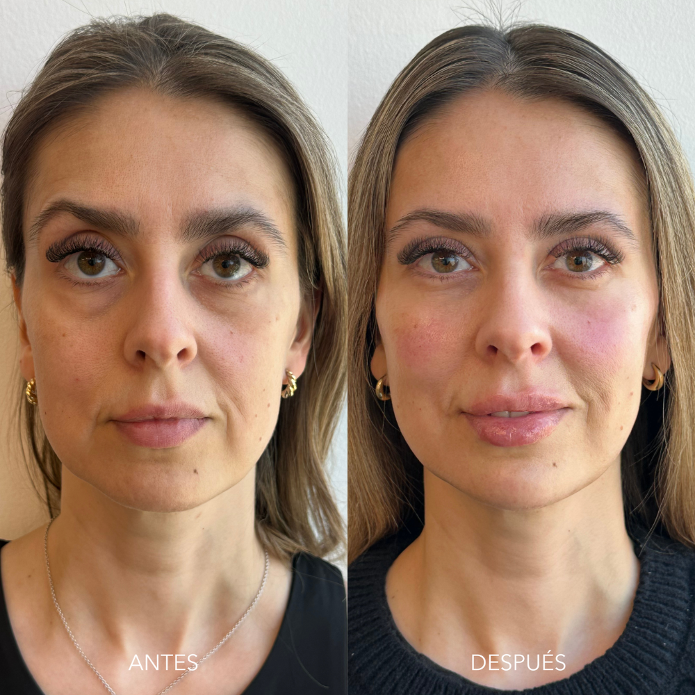 Armonización facial (desde 4 ml.)