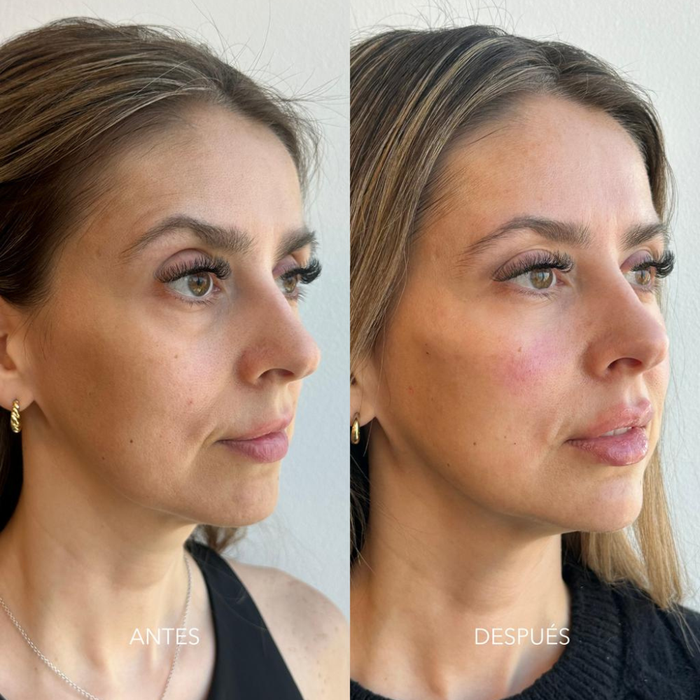 Armonización facial (desde 4 ml.) - Imagen 2