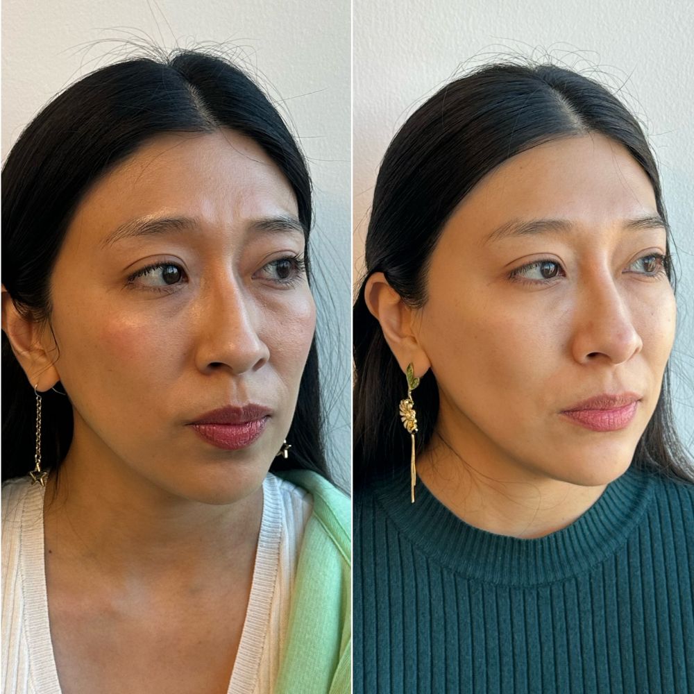 Armonización facial (desde 4 ml.) - Imagen 11