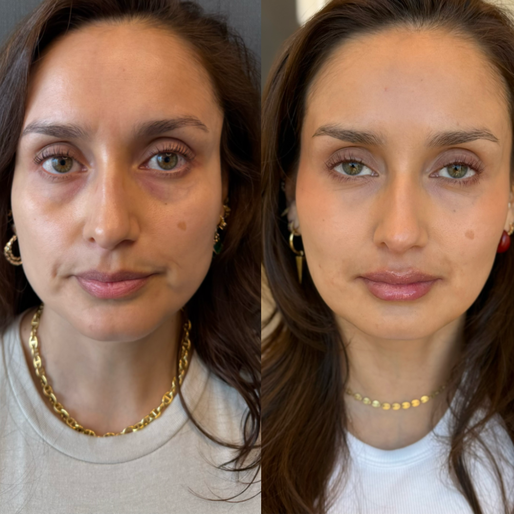 Armonización facial (desde 4 ml.) - Imagen 14