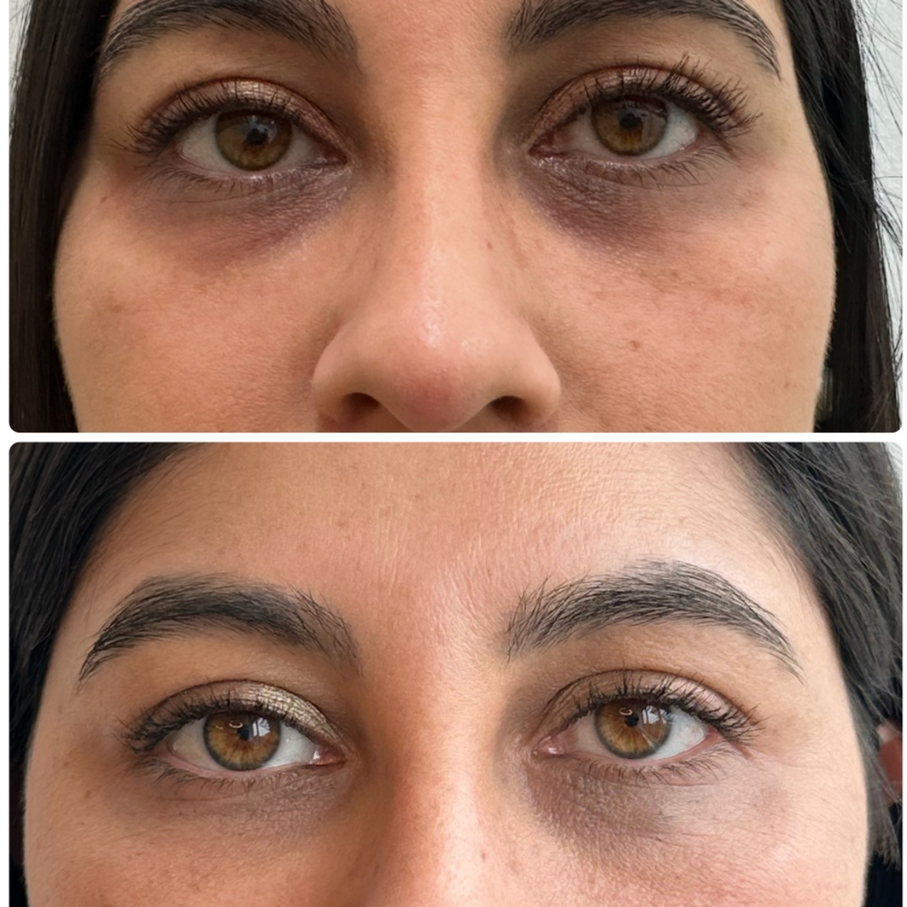 Meline Periocular (Ojeras Oscuras) - Imagen 2