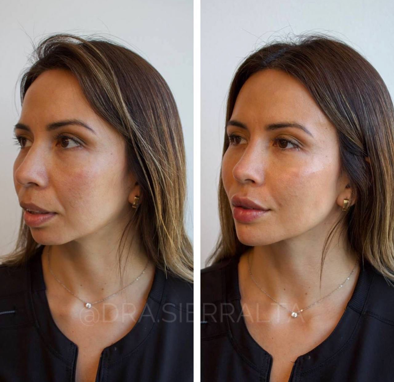 Armonización facial (desde 4 ml.) - Imagen 4