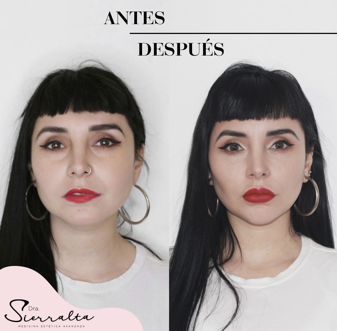 Armonización facial (desde 4 ml.) - Imagen 3