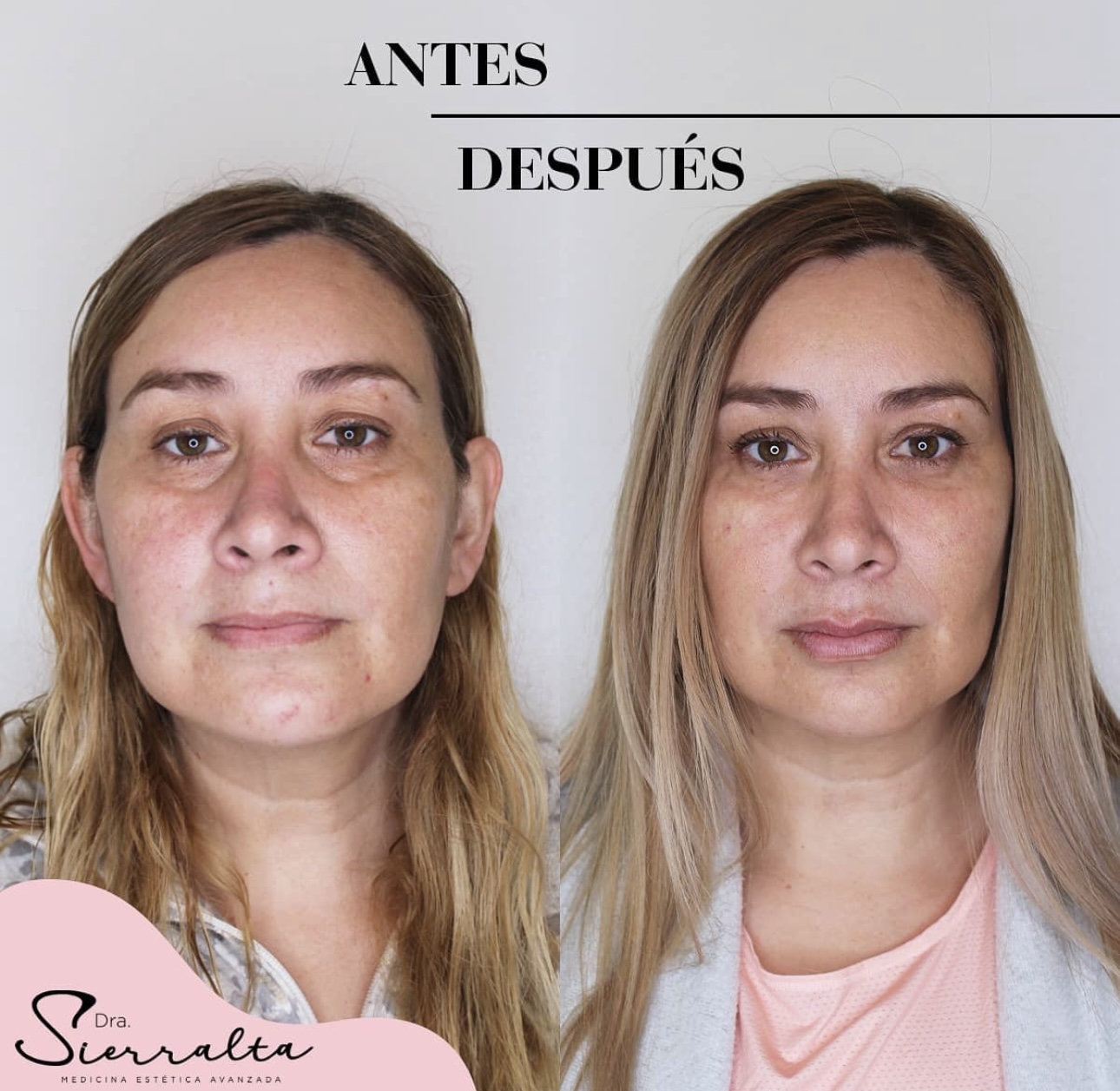 Armonización facial (desde 4 ml.) - Imagen 9