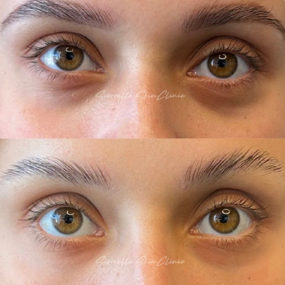 Pack Bye Bye Ojeras | Ácido hialurónico 1 ml. + 4 ses. Vitamina K.