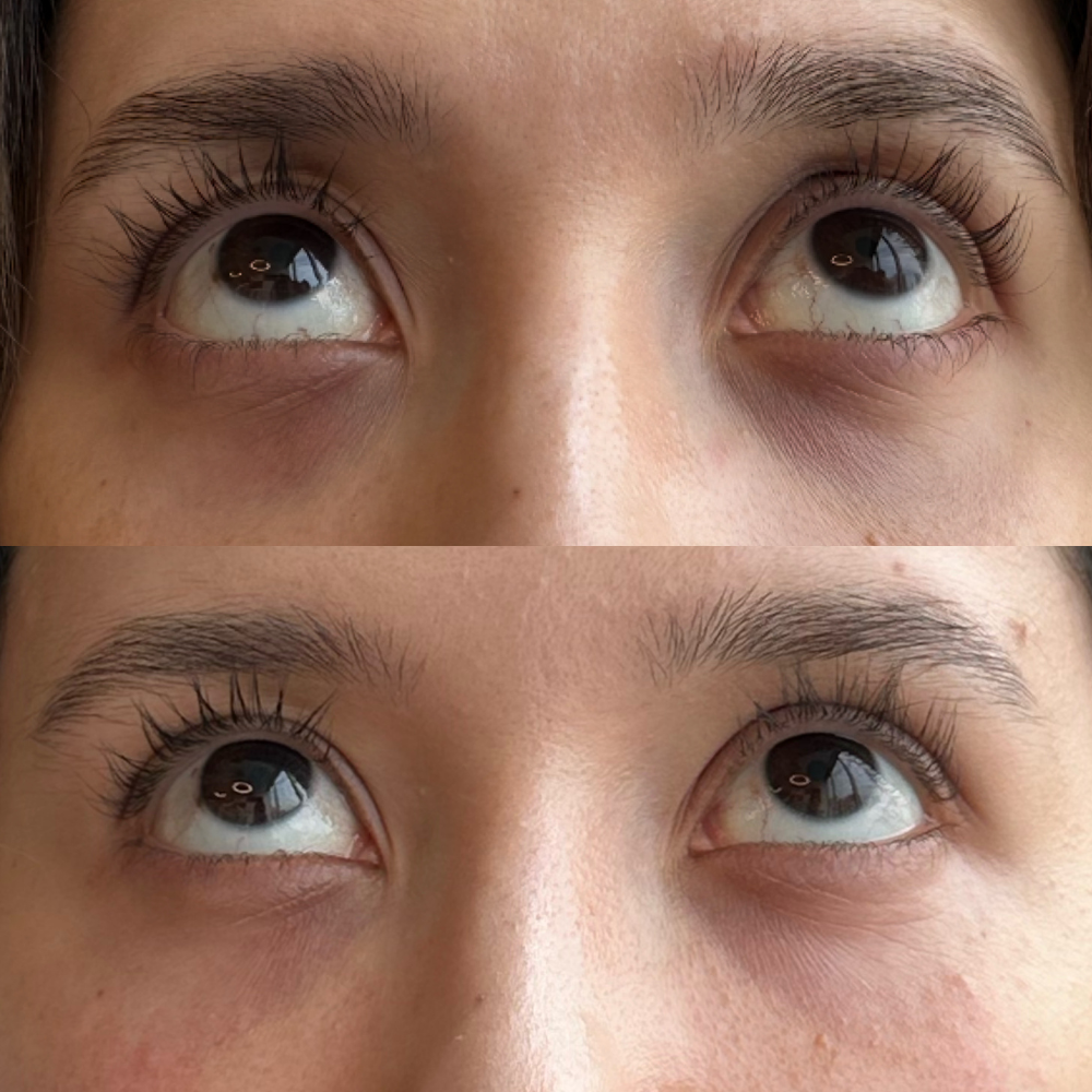 Pack Bye Bye Ojeras | Ácido hialurónico 1 ml. + 4 ses. Vitamina K. - Imagen 2